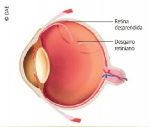 Desprendimiento de retina